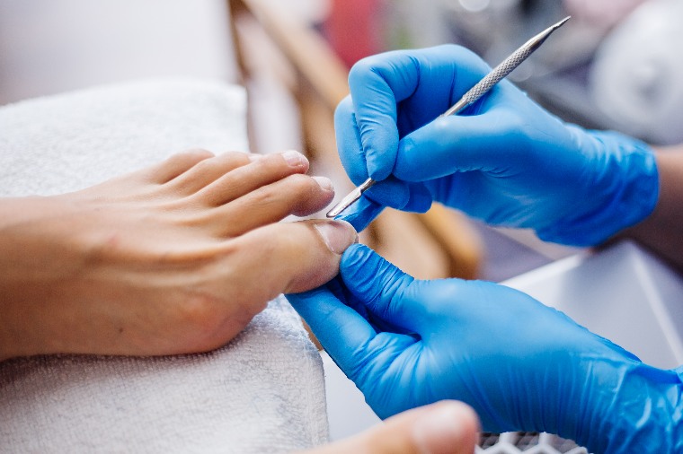 ingrown toenail
