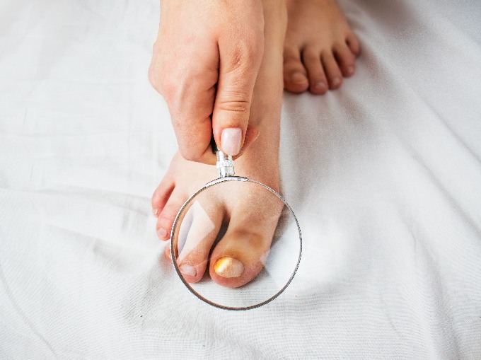 toenail mycosis